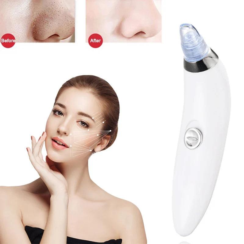 Blackhead And Acne Suction & Porescleaner - Bforbazaar