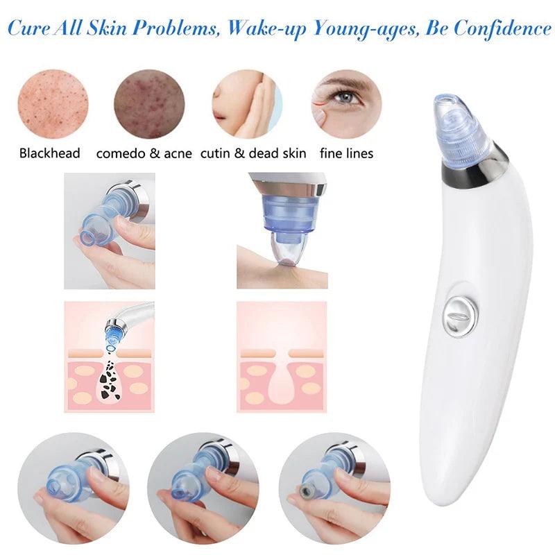 Blackhead And Acne Suction & Porescleaner - Bforbazaar